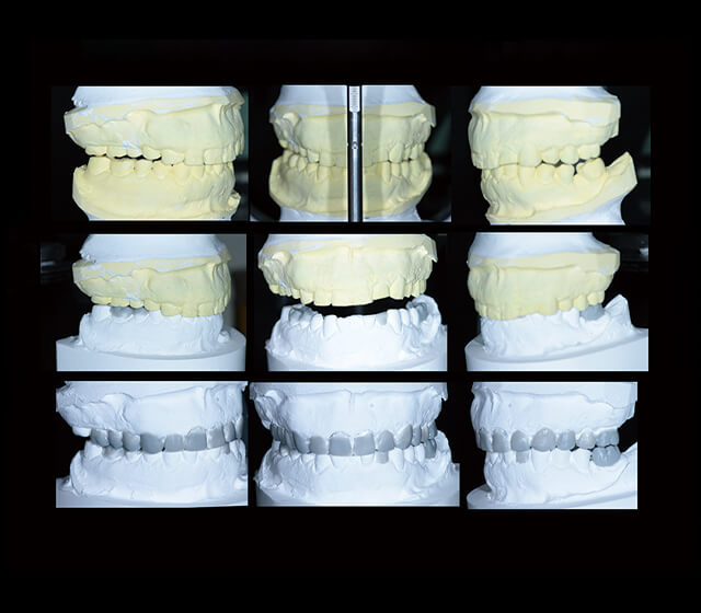 診断用ワックスアップ